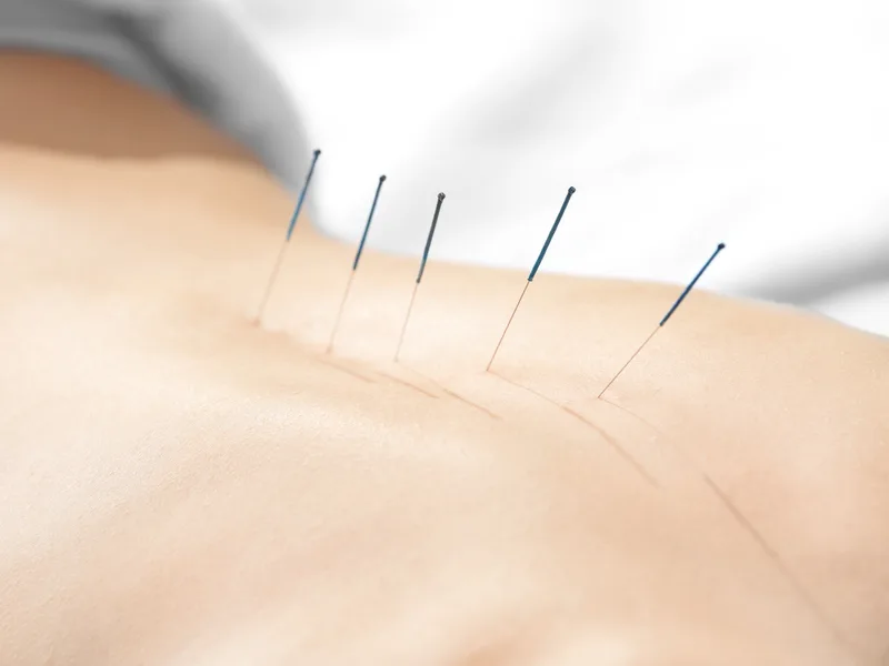 Acupuncture at Top Spine Chiropractic in Worcester