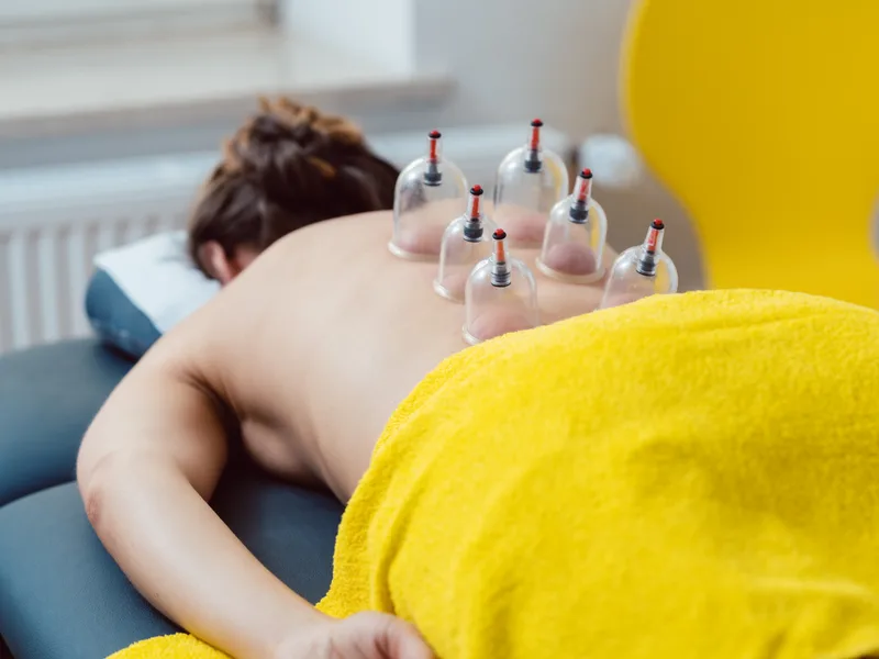 Cupping Therapy at Top Spine Chiropractic in Worcester