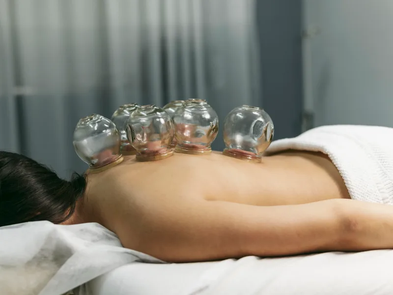 Cupping Therapy at Top Spine Chiropractic in Worcester
