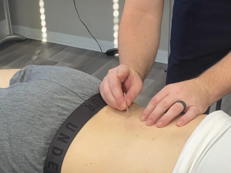How Dry Needling works at Top Spine Chiropractic