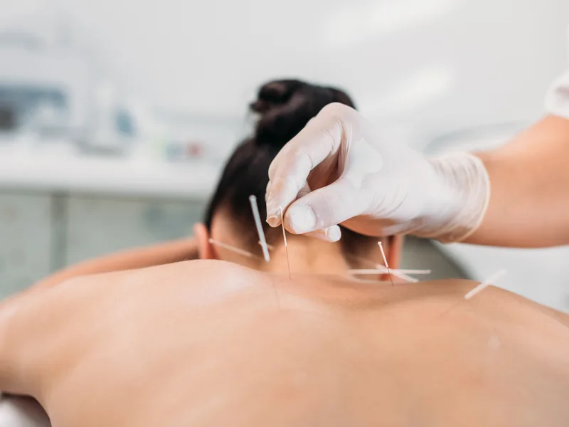 Dry Needling at Top Spine Chiropractic in Worcester