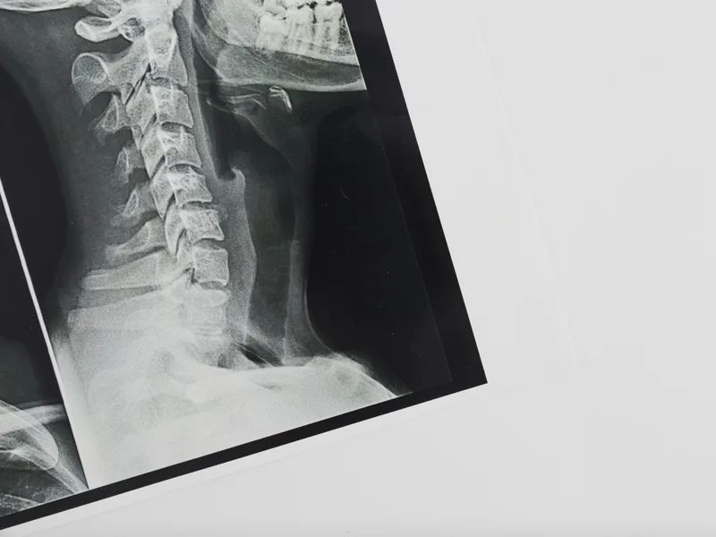 X-Rays at Top Spine Chiropractic in Worcester